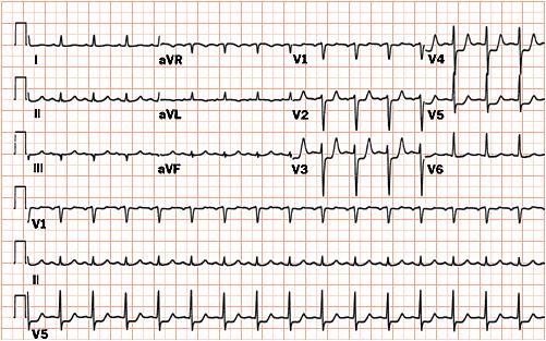76 year old female Prior Hypertension, Hyperlipidemia, Smoking On Hydrochlorothiazide, Atorvastatin New onset chest discomfort; 2 episodes in past 24 hours Heart rate 122/min; BP 170/92 mm Hg, Killip