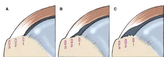 Habermeyer Subclassification Type 1 - small tear within transition zone from cartilage to bone Type 2 - tear up to
