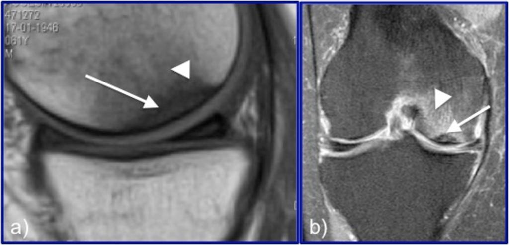 Fig.: Fig. 17. Marrow ischemia/infarction: Spontaneous osteonecrosis of the knee (SONK)Sixty-one-years-old man who presents with spontaneous knee pain.