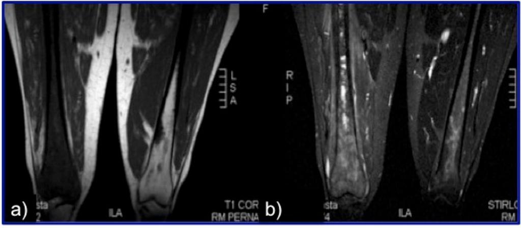 Fig.: Fig. 18. Marrow infiltration: OsteosarcomaThirteen-years-old boy. T1 sagittal image shows the predominantly low and intermediate signal intensity of the mineralized osteoid in bone marrow.
