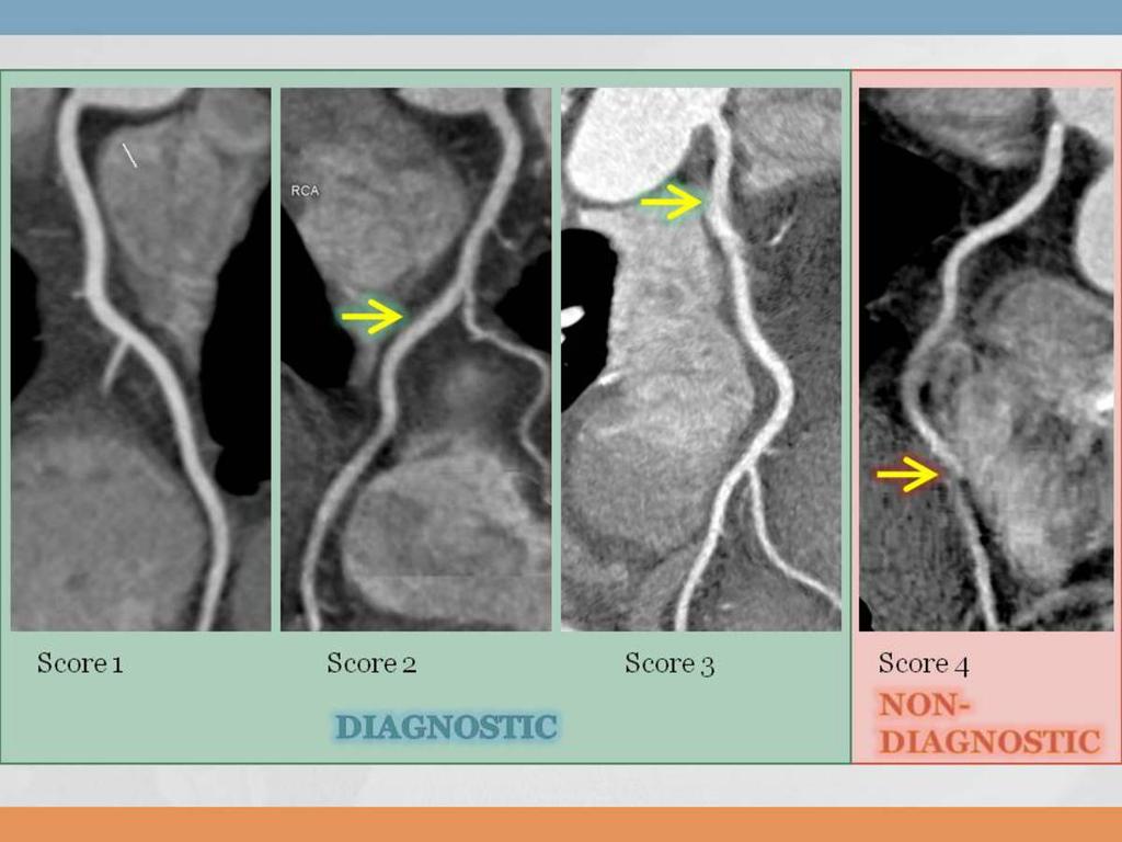 3)Attenuation difference between ascending and descending aorta(ada-d) Difference of mean values ROI in the ascending and descending aorta (figure 4)