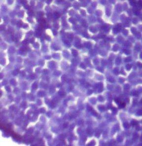 Fig. 6: Gynecomastia small clusters of ductal epithelial