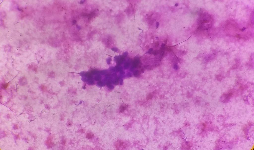 Inset (40X) Liquid based smear Pap stain Fig.