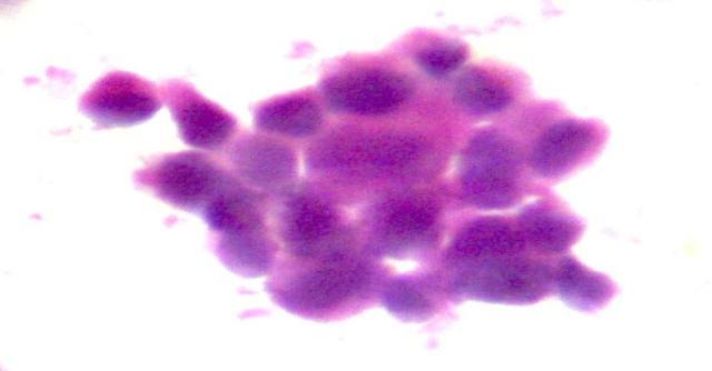 Inset (40X) (Liquid based smear Pap stain) Fig.