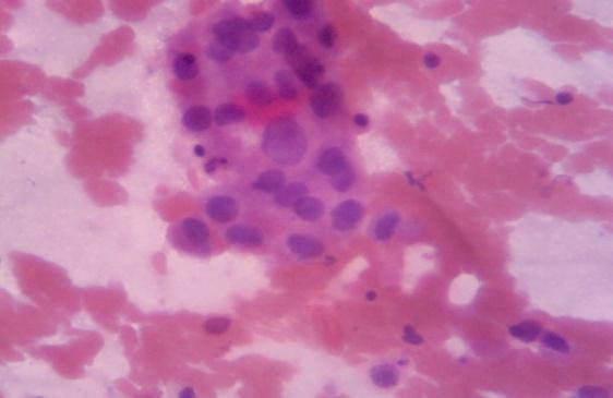 Inset (40X) Malignant ductal epithelial cells