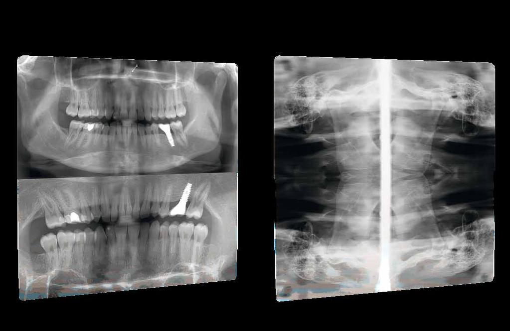 Panoramic IMPROVED ORTHOGONALITY PANORAMIC TMJ SECTIONS BITEWING MAXILLARY