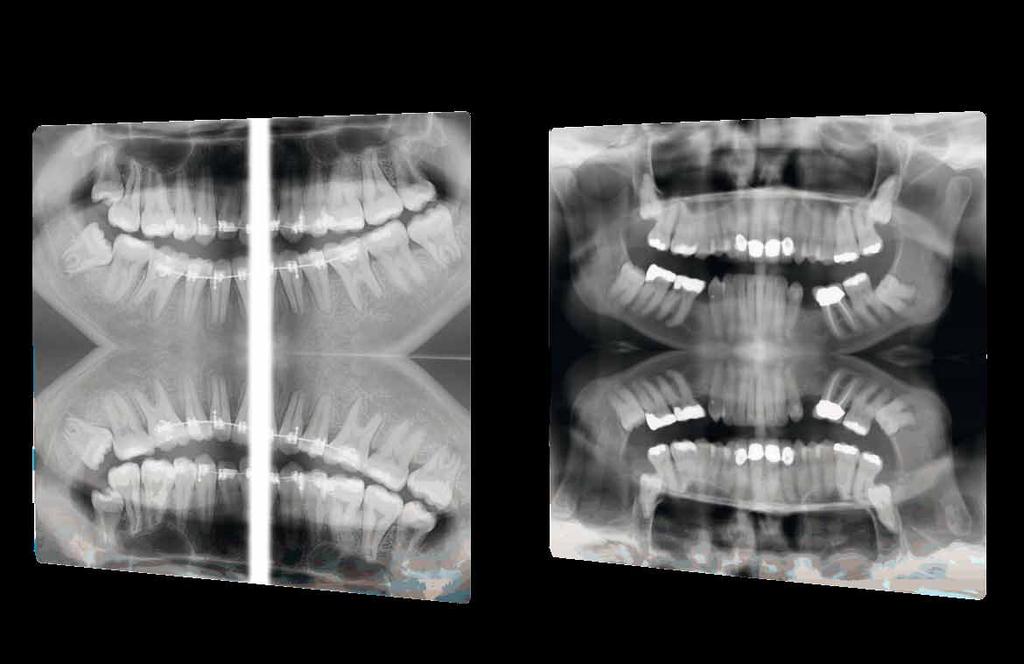 overlapping of crowns. Both open and closed mouth images.