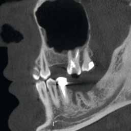 dose for the patient, for example: Hounsfield unit calibration on CBCT with WhiteFox. Allows accurate bone density measurement. ACE technology with SOP!