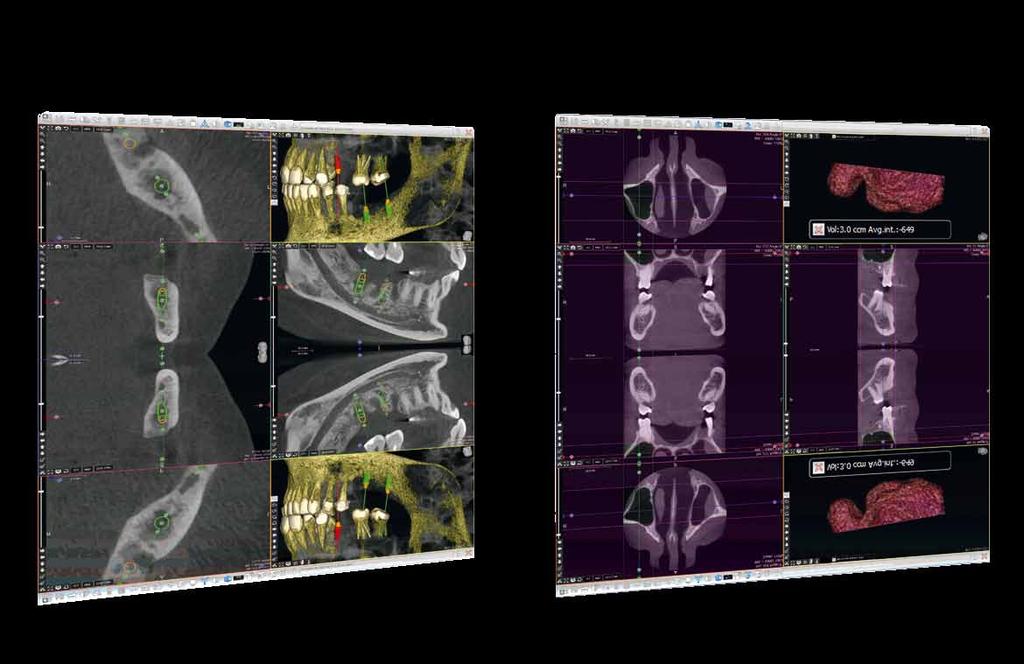 CBCT IMPLANT PLANNING SINUS LIFT BIOMATERIAL VOLUME CALCULATION VIRTUAL ENDOSCOPE GUIDED SURGERY The implant planning program is so intuitive and fast that you can explain the forthcoming surgery to