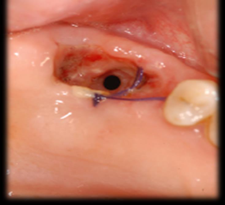Oroantral Communication (sinus perforation) OAC 4-5 mm will usually resolve w/o treatment Do not recommend placing