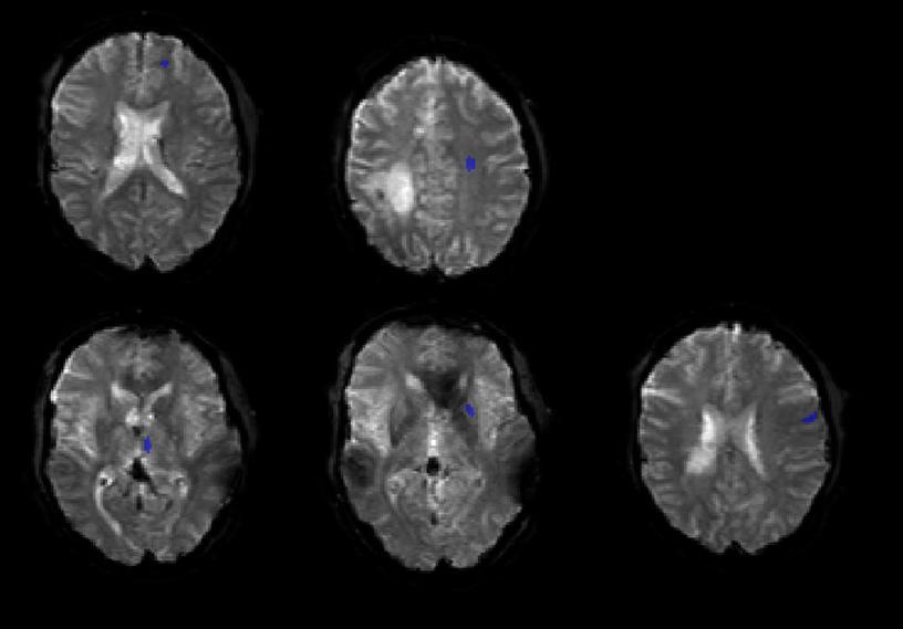 The mean CBV value from the bookend method was compared with the mean CBV value in the corresponding region from the DSC-MRI CBV map, and this provided a correction factor according to Eq. 2.