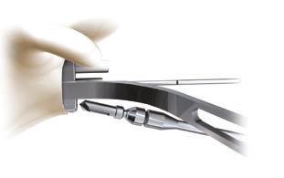 Note: The Glenoid Drill Guide is available in two sizes: S/M for the Keeled Glenoid sizes S and M, and size L for the Keeled Glenoid size L. Both sizes are available in left and right versions.