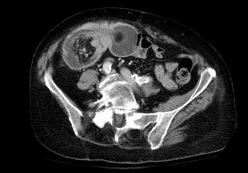 Our patient: Intraluminal fat and vessels on CT,