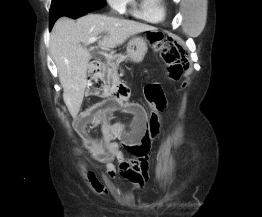 Our patient: Intraluminal fat and vessels on CT, labeled