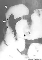 Operative treatment Esophageal, Gastric, Duodenal Uncommon locations for disease Surgical treatment limited to duodenum Degree of