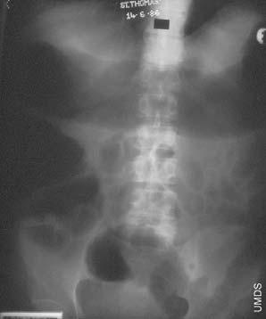 Operative treatment Colonic disease Indications for surgical