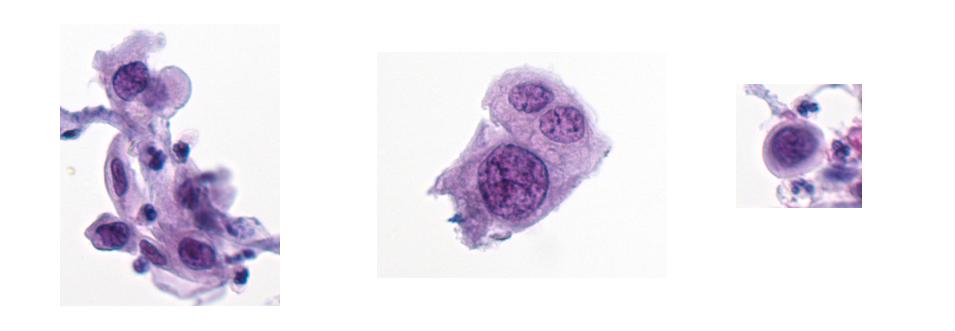 3 Method proposal 3.1 Cancerous (abnormal) cell characteristics Abnormal and normal cervical cells have some very significant features that are necessary for distinguishing between them.