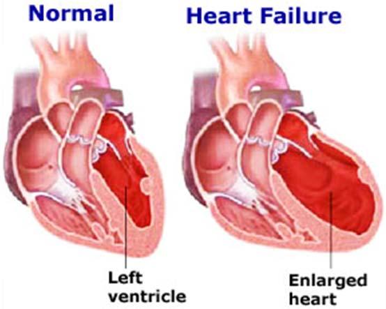 Etiology of Heart Failure Complex Clinical Diagnosis Results from any structural or functional impairment of ventricular filling or ejection of