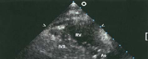 Two-dimensional (2D) echocardiographic image (parasternal long-axis