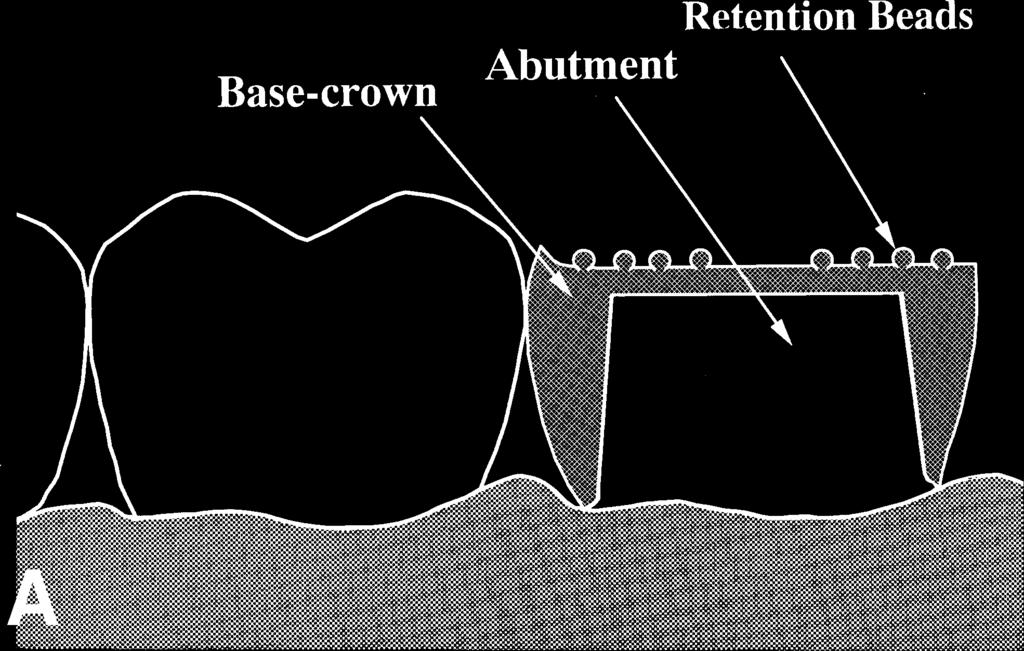 THE JOURNAL OF PROSTHETIC DENTISTRY Fig. 1. Diagram of artificial crown fabricated by double-casting method. A, Base-crown fitted to abutment intraorally.