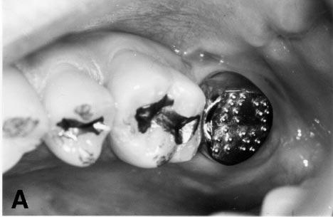 B, On occlusal surface of base-crown, occlusal structure is functionally developed intraorally by molding autocuring acrylic resin during functional movements of mandible.