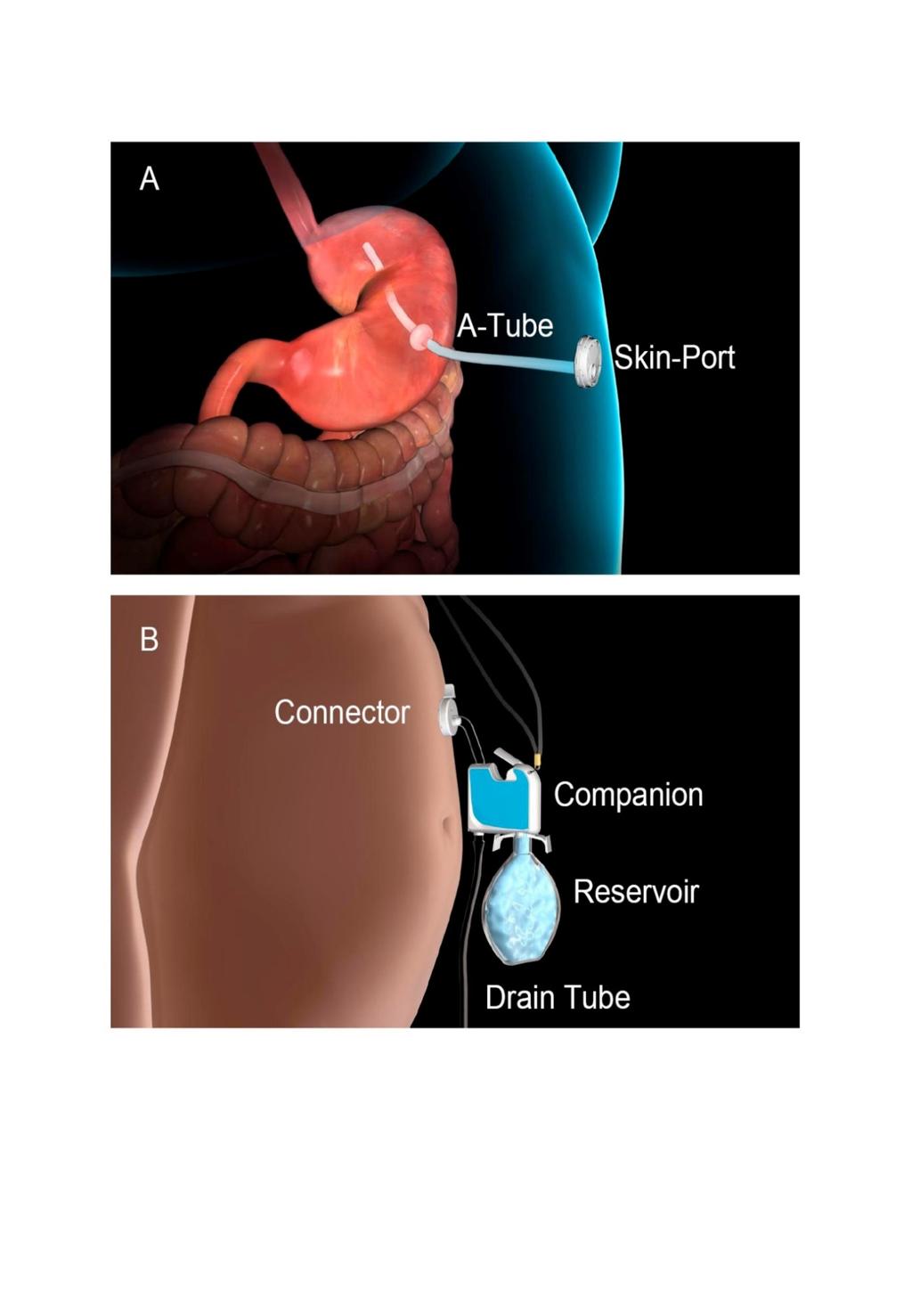 AspireAssist System (Aspire Bariatrics, King of Prussia, PA) Similar in concept to a percutaneous