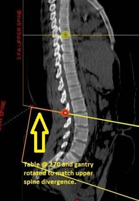 Lower spine field creation Kick table to 270 Rotate gantry to match divergence of upper spine field