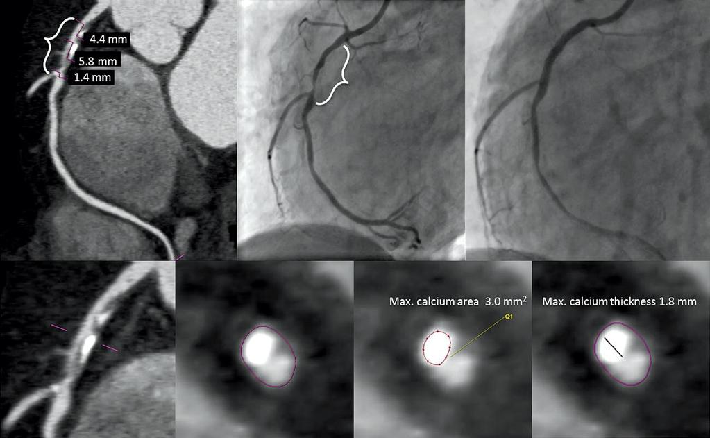 A B C D E F G Fig. 2. Calcium measurements within the coronary lesion detected by CTCA.