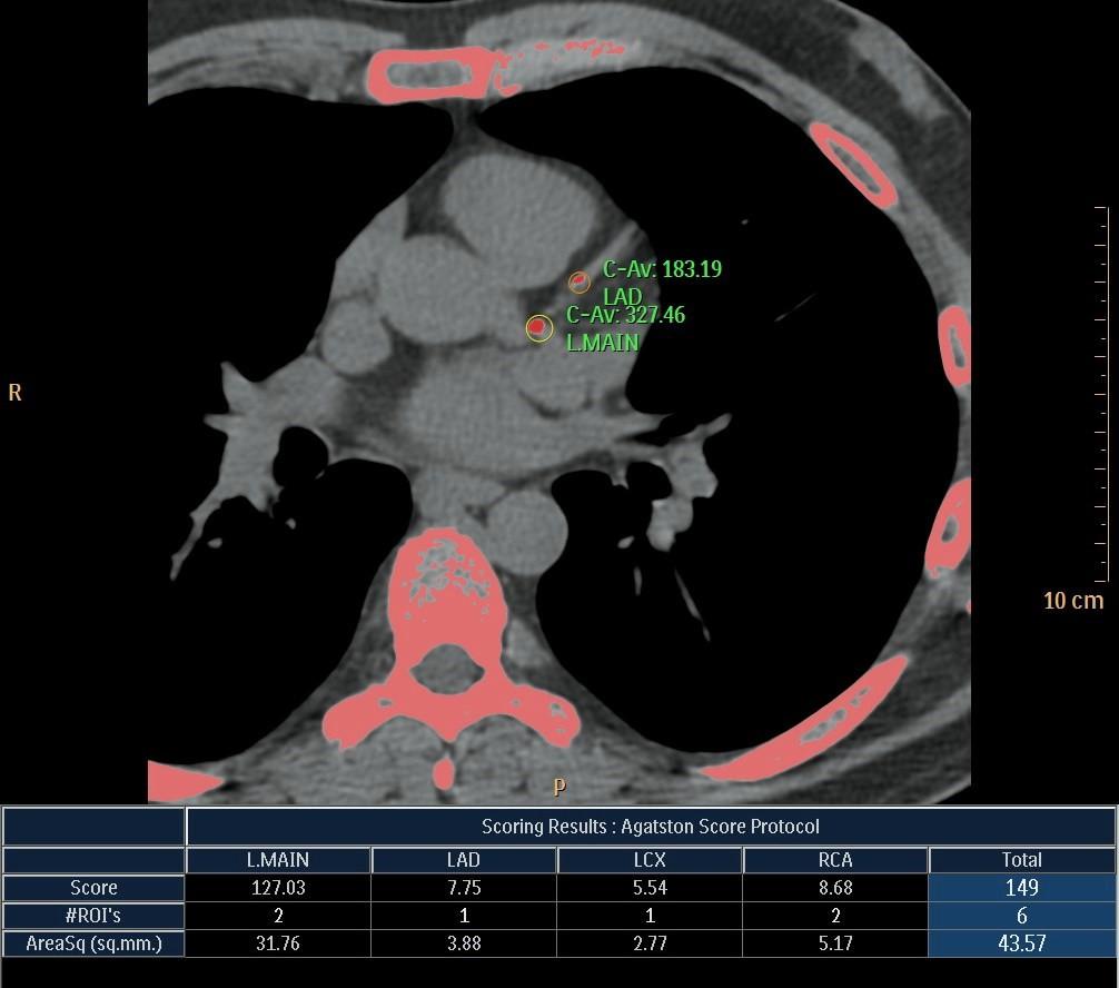 CT Scan Agatston The semiautomatic Agatston scoring software calculates the product of the calcified plaque area within a CT slice and incorporates a plaque-specific