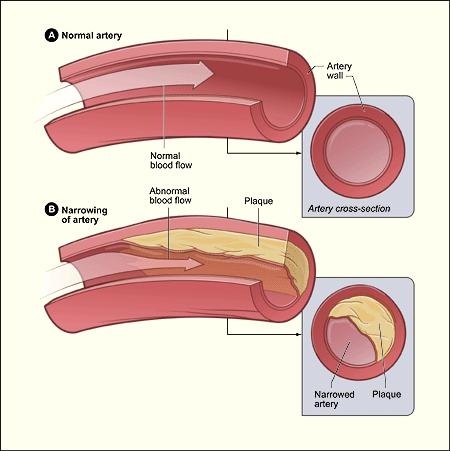 Atherosclerosis begins with damage to the endothelium, a thin layer of cells that line the arteries.