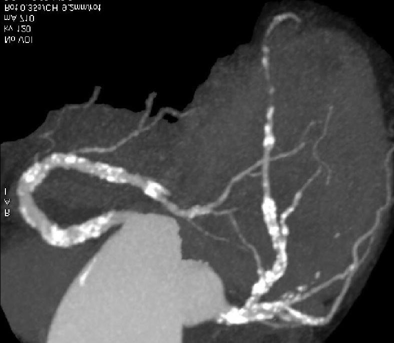 Calcified Coronary Arteries Intuitive for CVS Risk Look for disease!