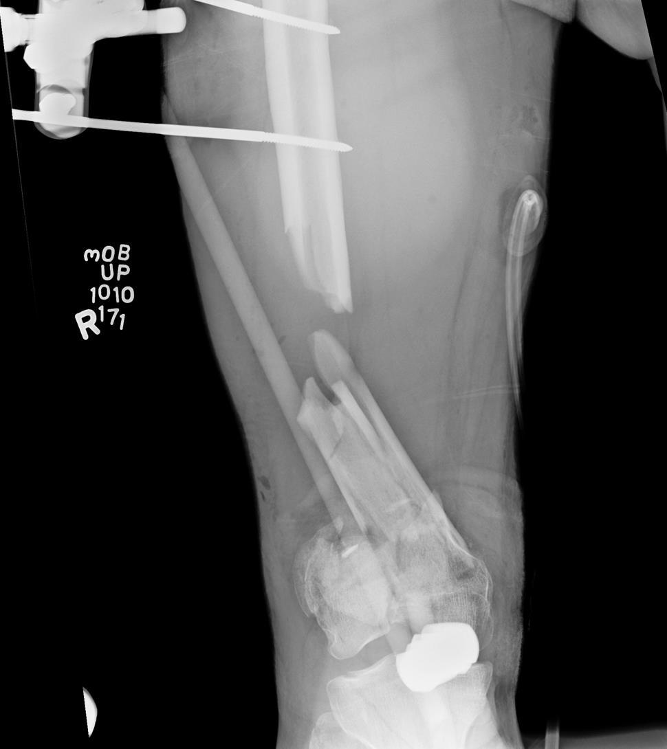Salvage Techniques Bone Ex Fix ORIF IM nail Bone