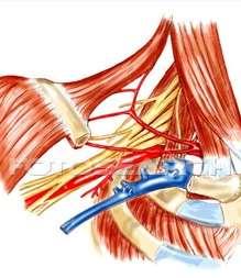 Axillary Artery Access Advantages Large artery Central location allows interventionist to reach almost any site.