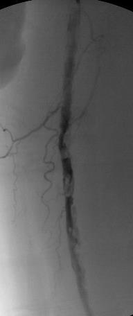 0.014 Wire Platform Multiple high grade lesions due to eccentric plaque although most of the lumen is patent for much of the vessel Goal is to avoid going subintimal and use a wire that will allow