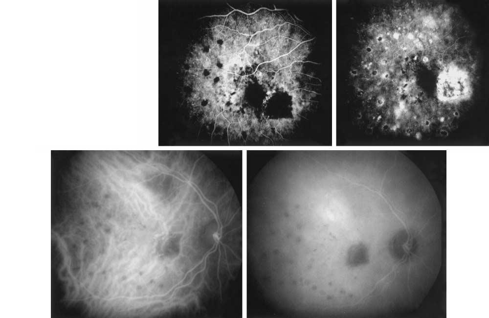 A B C Early OD Late OD D E Early OD Late OD Figure 3. A, One month posttreatment, fundus examination results show flattening of the retinal pigment epithelial detachment with a nasal laser scar.