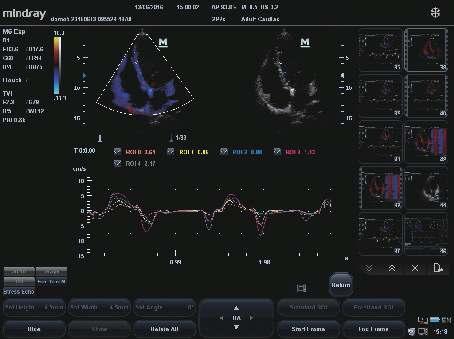 5 hours Fast response, booting up in seconds ineedle Cardiology Free Xros M(Anatomic M mode): multi-region analysis of up to 3 sample lines simultaneously Free Xros CM (Curved