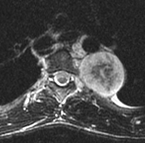 Malignant Peripheral Nerve Sheath Tumor (MPNST) 50%-80% sporadic