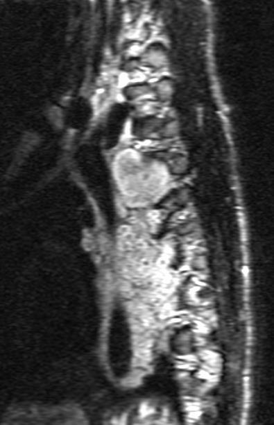 size nerves Extremity (33%-46%) Trunk (34%-41%) Head and neck
