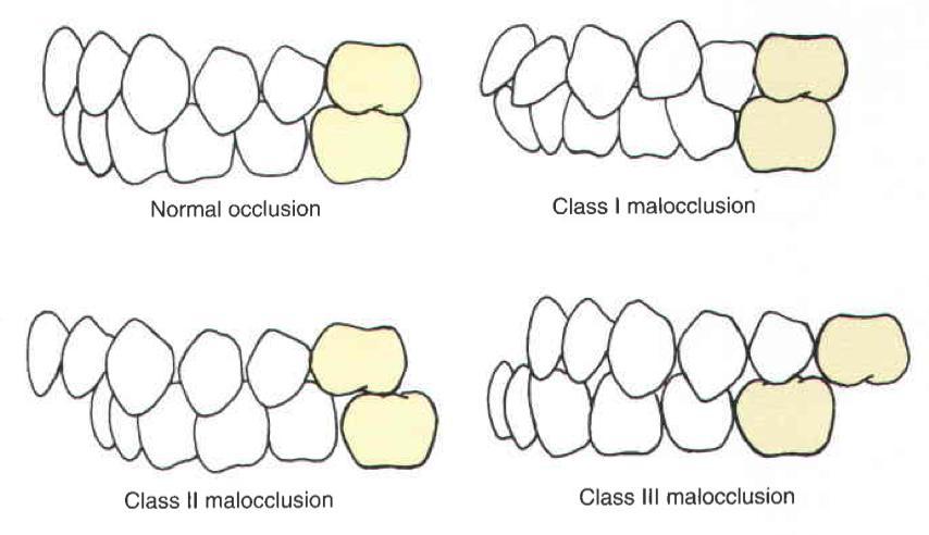 Angle s classification Normal occlusion Class I