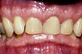 extreme overbite, so that the lower incisors contact to the palate, can cause significant tissue damage, leading to