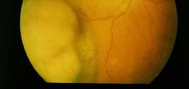 Tumor regression After Eye Plaque BT 12
