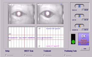 LINAC based SRT @ MUW (II) Vienna Stereotactic head fixation with non invasive eye