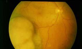 Ocular Anatomy Sclera: thickness resistant Radiosensitive Uvea: choroid ciliary body iris Retina: 0.3 1 mm extremely radiation 0.3 mm 2.0 mm 0,5 3 mm 0.