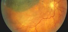 Management of posterial uveal melanoma (I) Various factors influencing therapeutic choice Periodic observation (very flat lesions) Transpupillary thermotherapy or photodynamic
