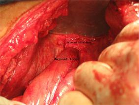 ligated hepatic duct with dilatation of the bile ducts
