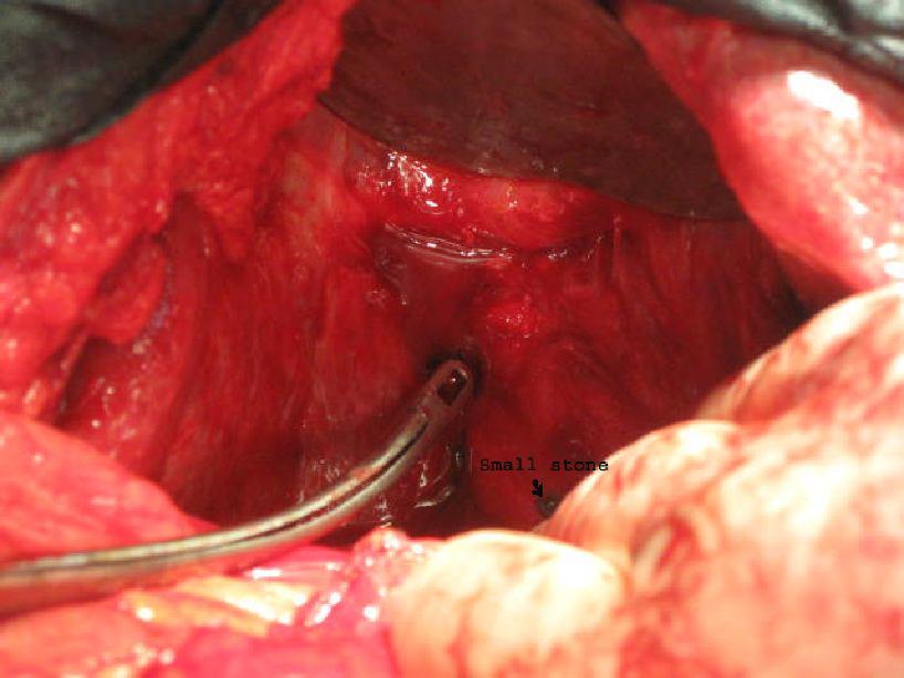 Fig 7. Stone evacuation from bile ducts proximal to anastomotic stricture. Fig 8. Healthy mucosa and wide lumen of the right and left hepatic ducts after excision of scar tissue.