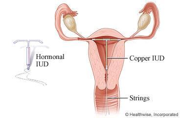 IUD (Intra-Uterine Device) An IUD, or intra-uterine device, is a small T-shaped piece of plastic or plastic and metal that is inserted into your uterus.