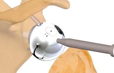 impeding impaction of the cup and impact it 6 Definitive implants REHABILITATION Short-term immobilization (according to the surgeon's assessment) with mobilization in neutral rotation to
