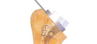 REVERSIBLE IMPLANT REMOVAL 1 Humeral cup and sutures removal: Remove the cup by sliding a
