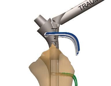 of the prosthetic head The size selected depends on the anatomy of the tuberosities The volume of the trial graft